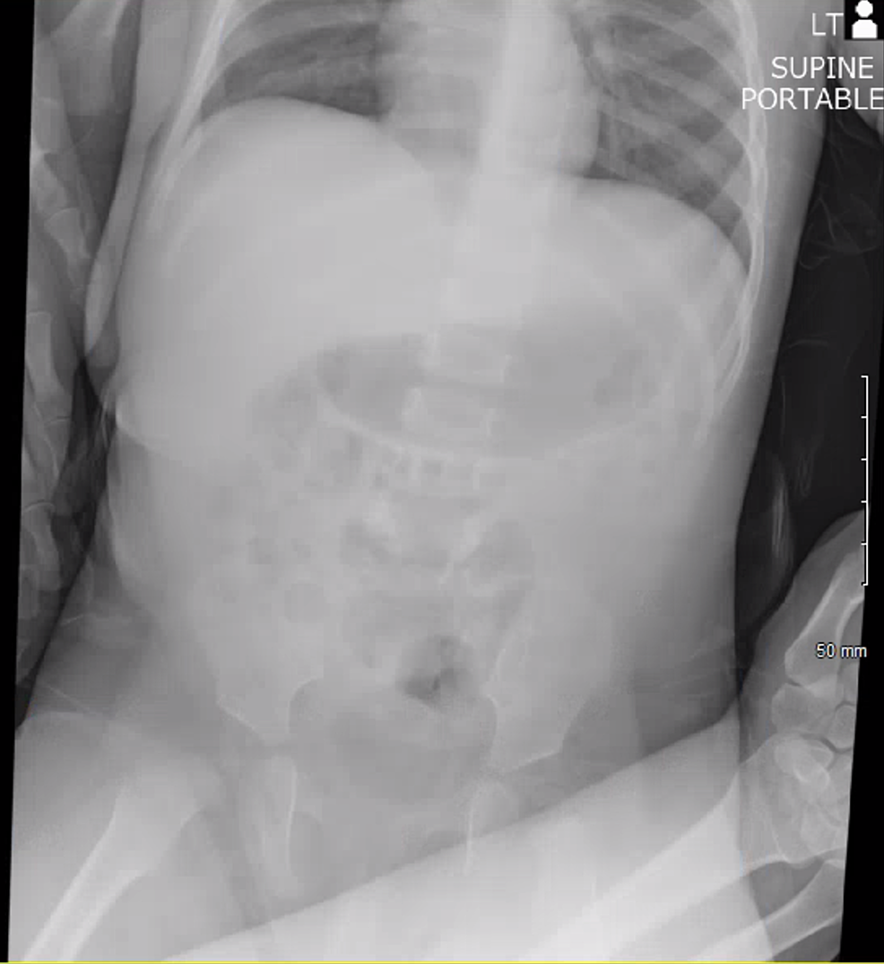 intussusception x ray