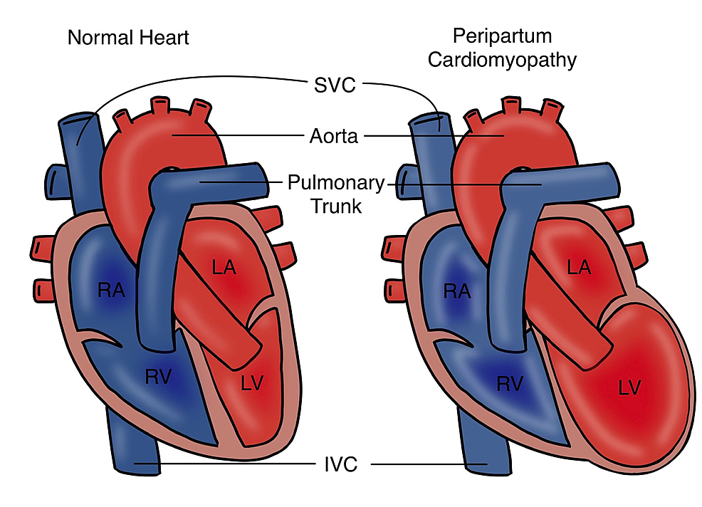 Cureus  Left Ventricular Global Longitudinal Strain in Patients