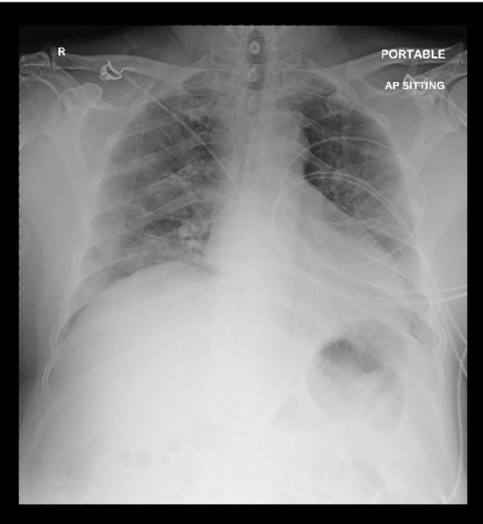 Chest-X-Ray-showing-right-middle-and-lower-zone-patchy-airspace-opacities-without-pleural-effusion-or-pneumothorax