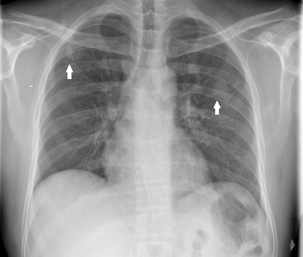 A Severe Case of Disseminated Multifocal Methicillin-Susceptible ...