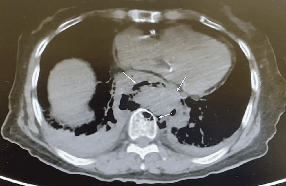 CT-abdomen-and-pelvis-without-contrast.-Air-fluid-levels-are-apparent-in-the-mediastinum-as-well-as-the-vertebral-body.-Aortic-involvement-is-also-highlighted-(arrows).