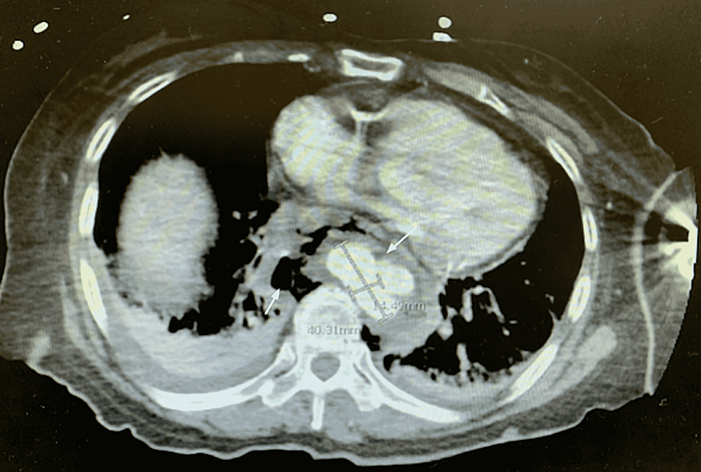 CT-chest-with-contrast-demonstrating-a-pseudoaneurysm-of-the-aorta-(measurements)-and-air-fluid-levels-in-surrounding-tissues-(arrows).