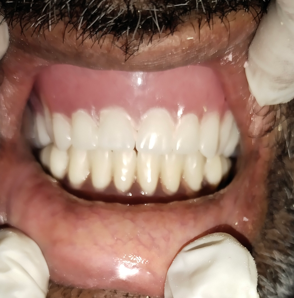Cureus ImplantSupported Overdenture Using Ball Attachments in