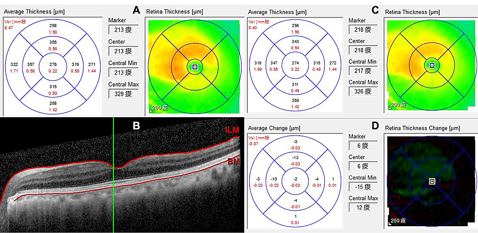 Optical-coherence-tomography-of-the-macula