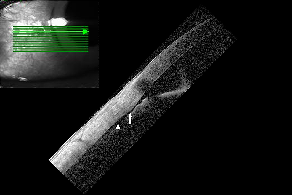 Optical coherence tomography of the anterior segment of the nasal angle of the left eye