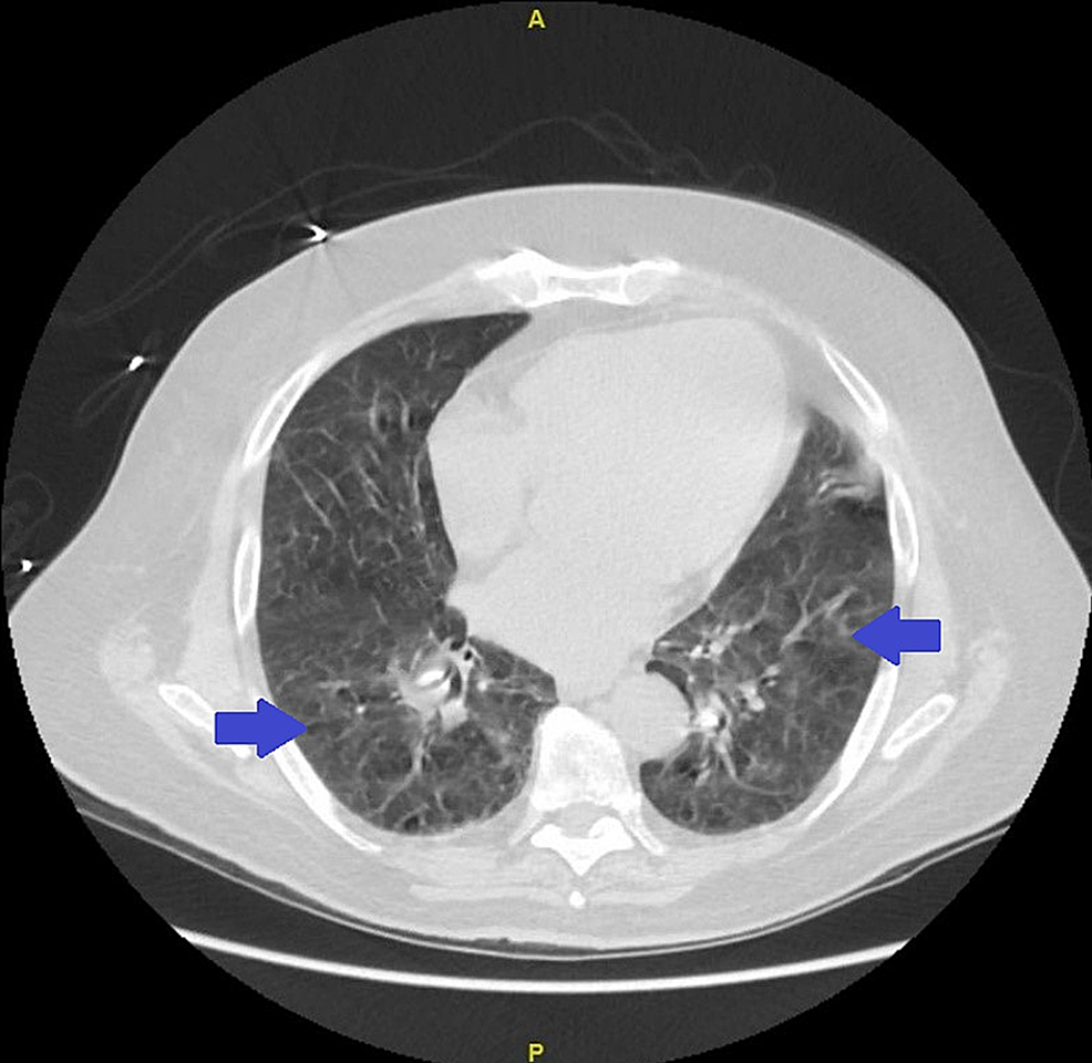 Computed-tomography-(CT)-of-chest-showing-increased-lung-markings-with-scattered-bilateral-ground-glass-opacities-(GGO)-(blue-arrow)