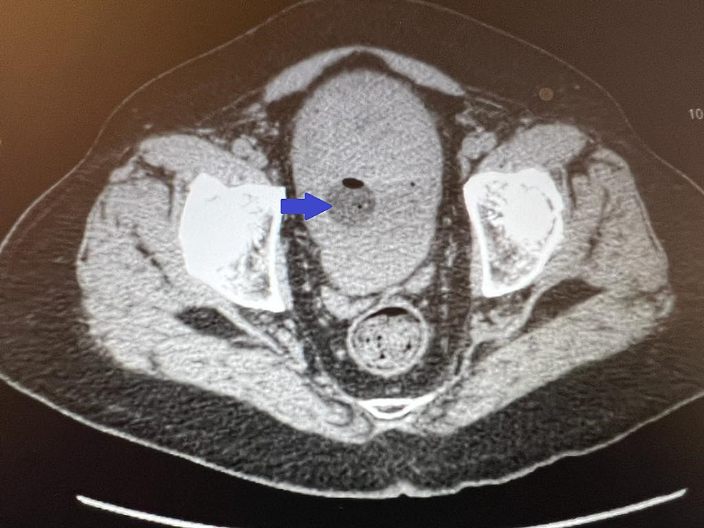 Computed-tomography-(CT)-of-abdomen-and-pelvis-showing-a-large-filling-defect-within-the-urinary-bladder-suspicious-for-a-blood-clot-(blue-arrow)