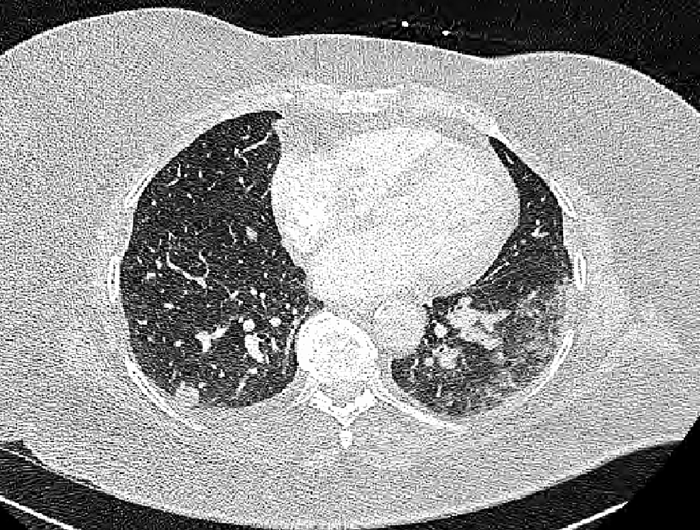 Breast Cancer Secondary to Radiation Therapy in a Patient With Wilms