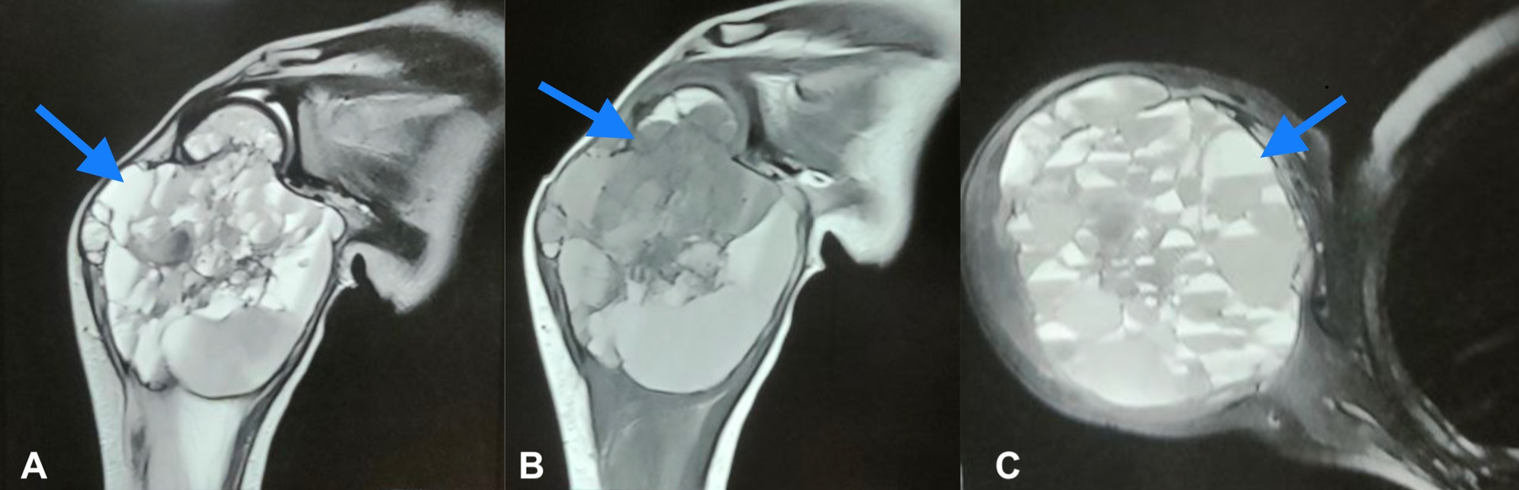 Cureus A 5 Year Old Female With An Aneurysmal Bone Cyst Of The Proximal Humerus 7805