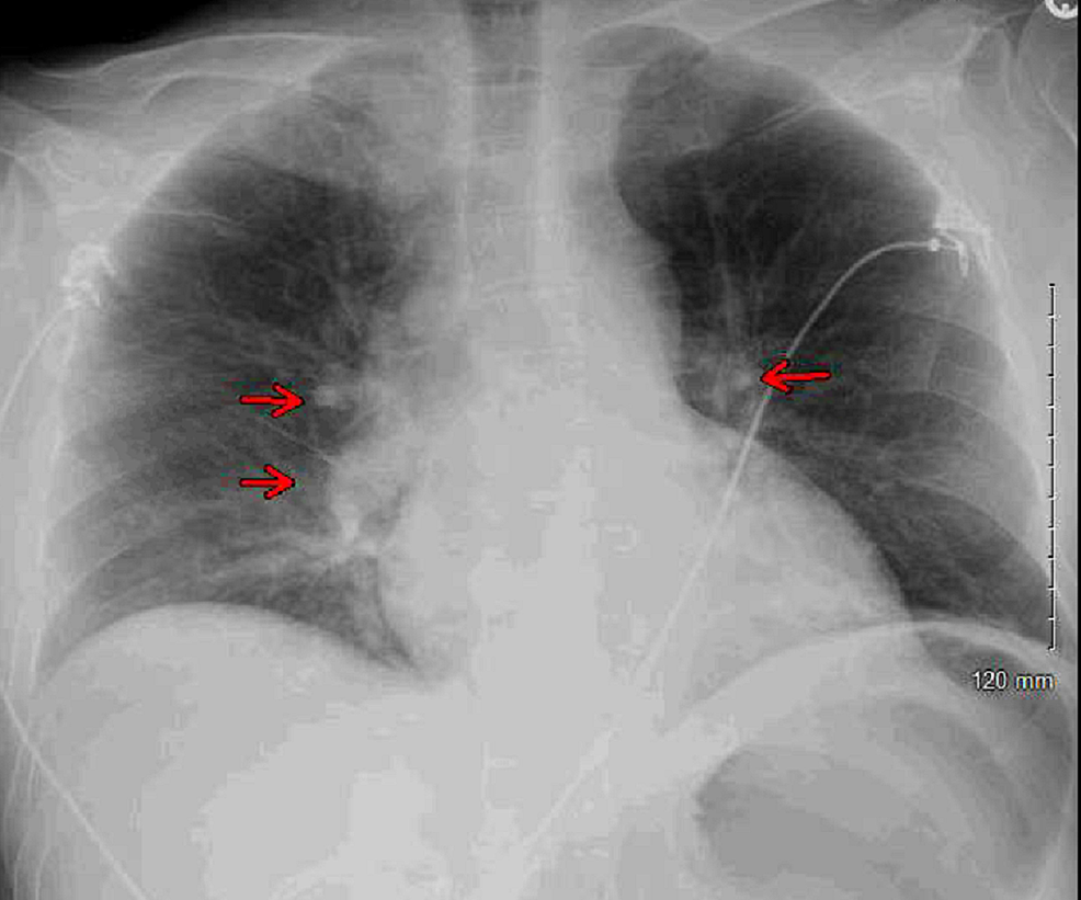 Chest-X-ray-revealed-bilateral-perihilar-patchy-and-hazy-airspace-opacities-(red-arrows).