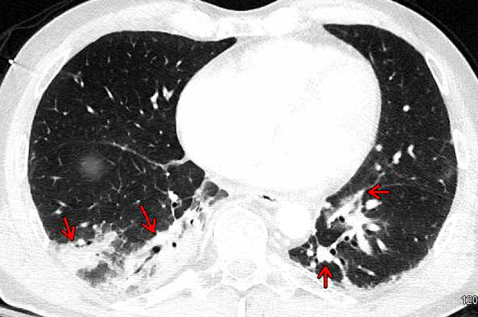 Computed-tomography-of-the-chest-with-contrast-axial-view-revealed-bibasilar-right-greater-than-left-consolidations-and-ground-glass-opacities-(red-arrows)-with-subsegmental-atelectasis-suggestive-of-pneumonia.-