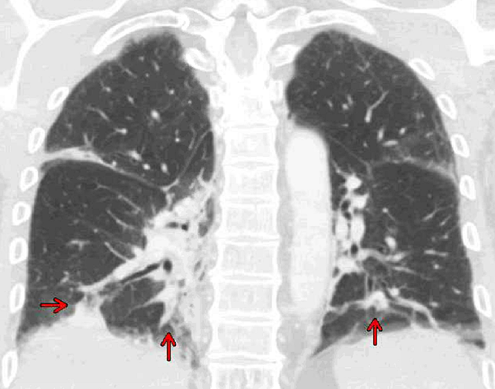 Computed-tomography-of-the-chest-with-contrast-coronal-view-revealed-bibasilar-right-greater-than-left-consolidations-and-ground-glass-opacities-(red-arrows)-with-subsegmental-atelectasis-suggestive-of-pneumonia.-