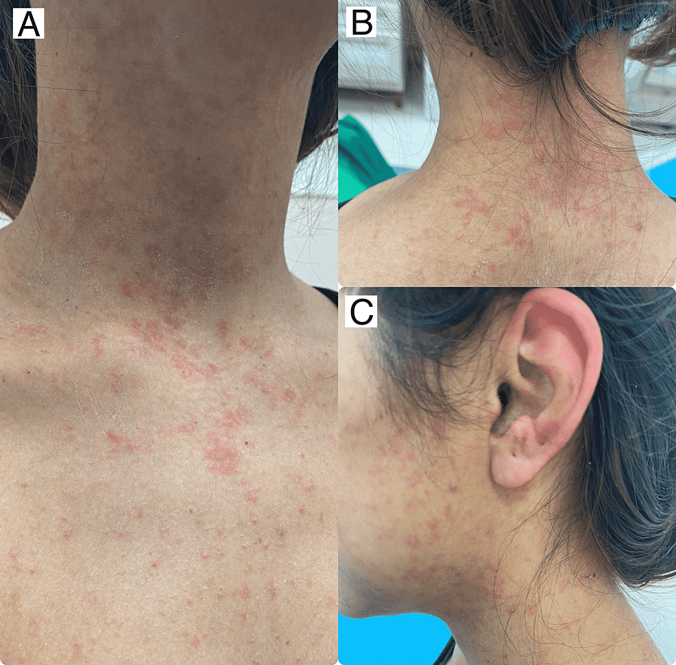 morbilliform-eruption-after-administration-of-second-dose-of-oxford