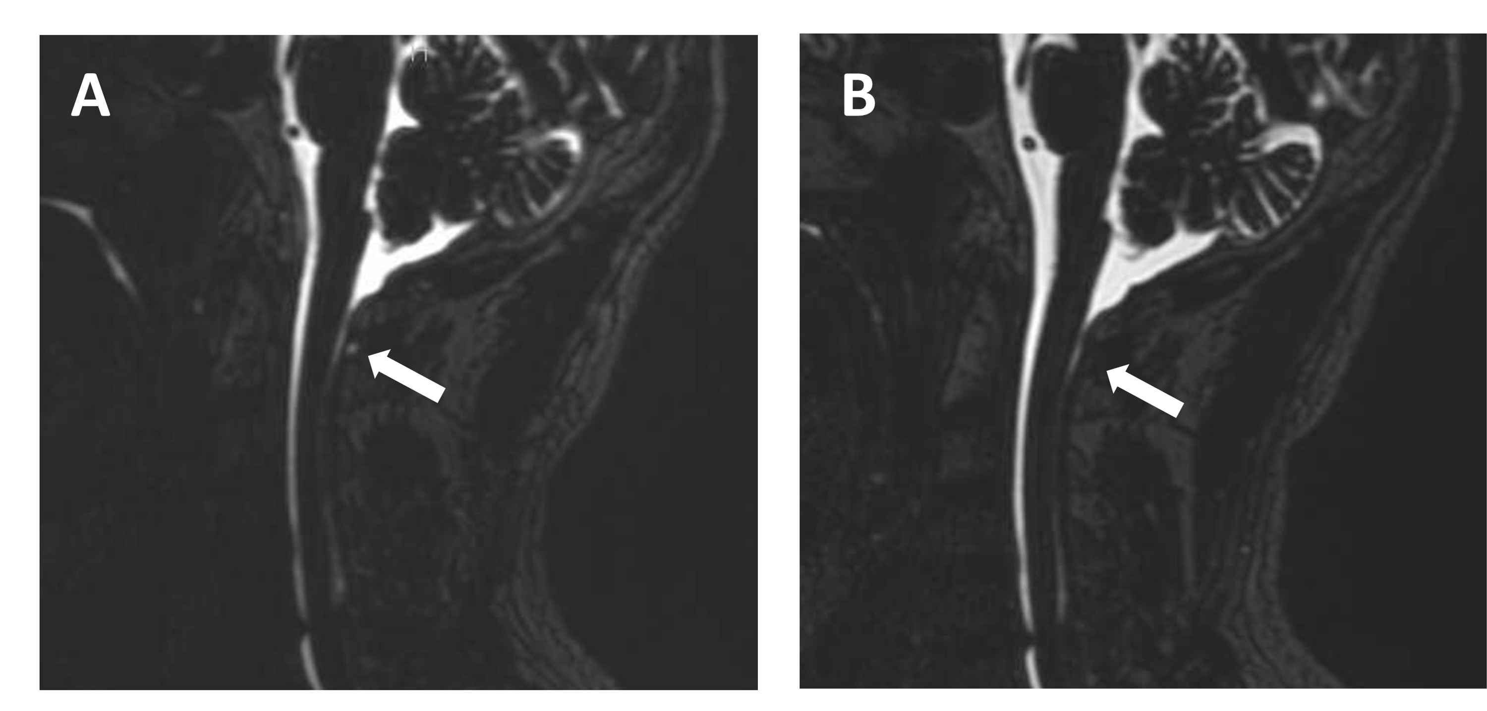 Cureus Epidural Blood Patch Using a Racz Catheter for Spontaneous