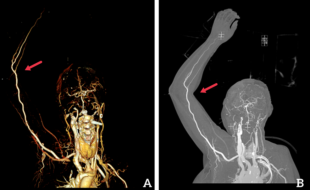 Computed-tomography-angiogram-(CTA)-of-right-upper-extremity:-(A)-three-dimensional-reconstruction-view,-(B)-coronal-reconstruction-view.-Red-arrow-indicates-the-location-of-the-hematoma.