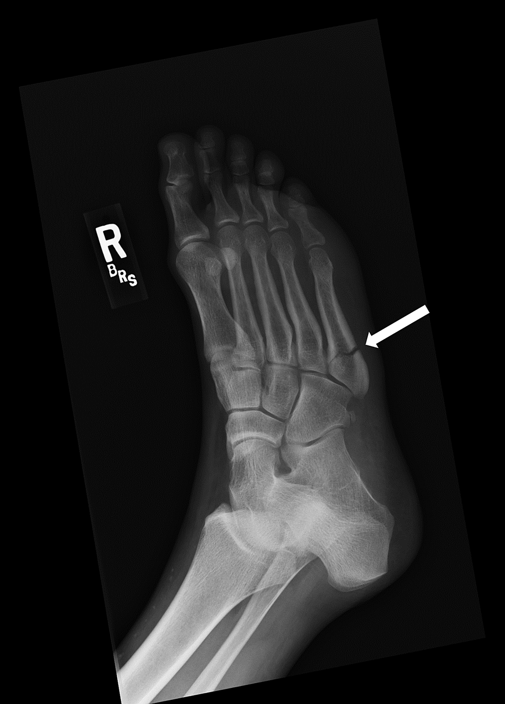 Oblique-radiograph-of-the-right-foot-demonstrating-a-mildly-displaced-transverse-fracture-of-the-proximal-fifth-metatarsal-(arrow).