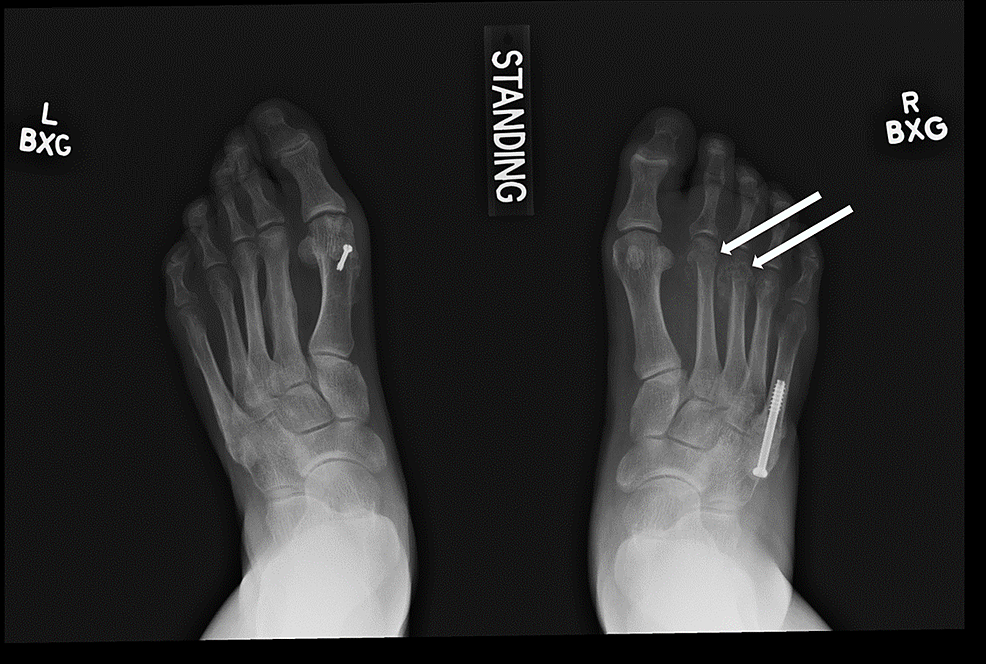 Anteroposterior-radiograph-of-bilateral-feet-demonstrating-second-and-third-metatarsal-neck-fractures-of-the-right-foot-(arrows).