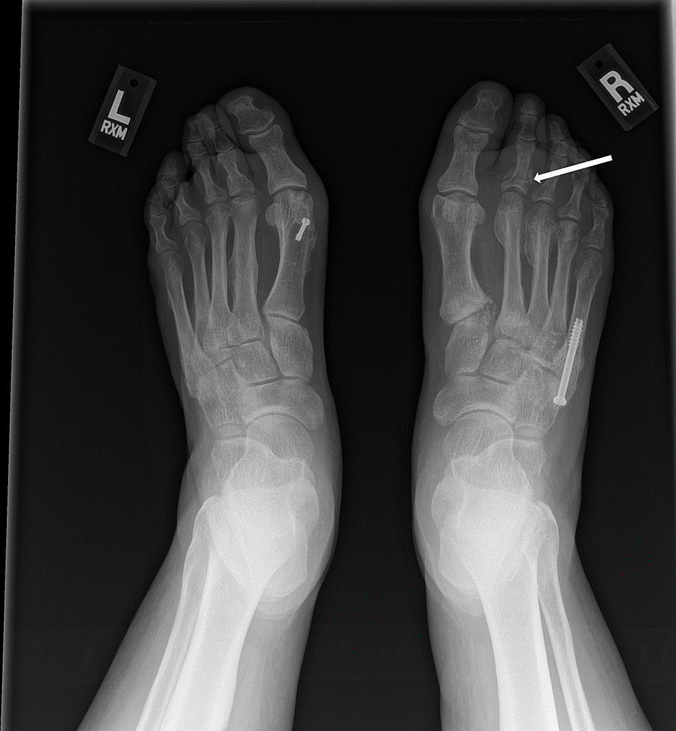 AP-radiograph-of-bilateral-feet-demonstrating-a-subacute-fracture-of-the-second-proximal-phalanx-of-the-right-foot-(arrow).