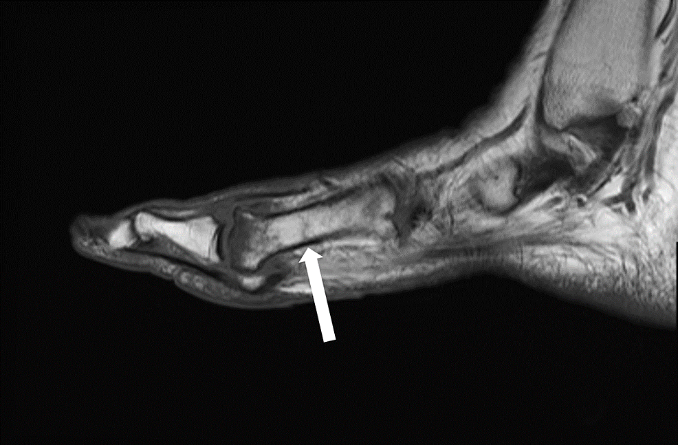 T1-weighted-sagittal-MRI-of-the-right-foot-demonstrating-a-first-metatarsal-shaft-stress-fracture-(arrow).