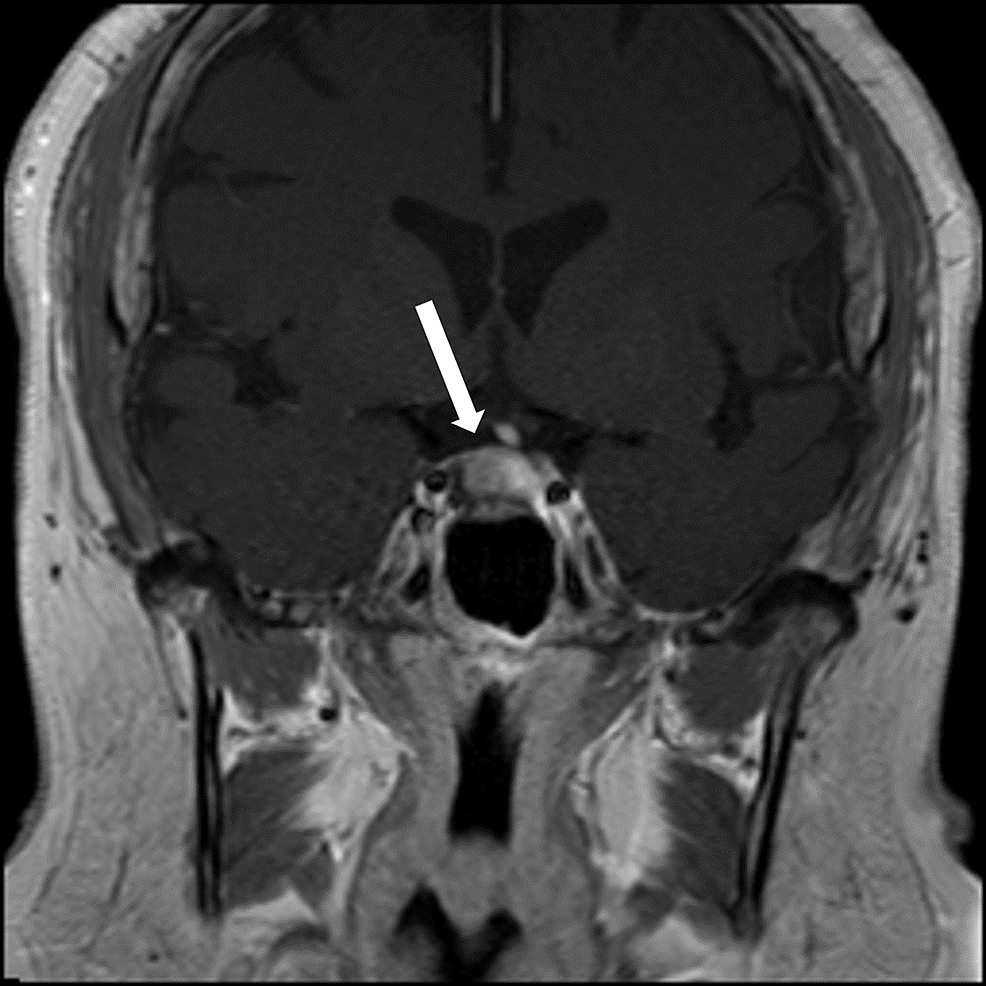 T1-weighted-coronal-MRI-of-the-pituitary-demonstrating-a-1.1-cm-×-1.5-cm-×-1.1-cm-cystic-sellar-mass-which-represents-a-pituitary-macroadenoma-(arrow).