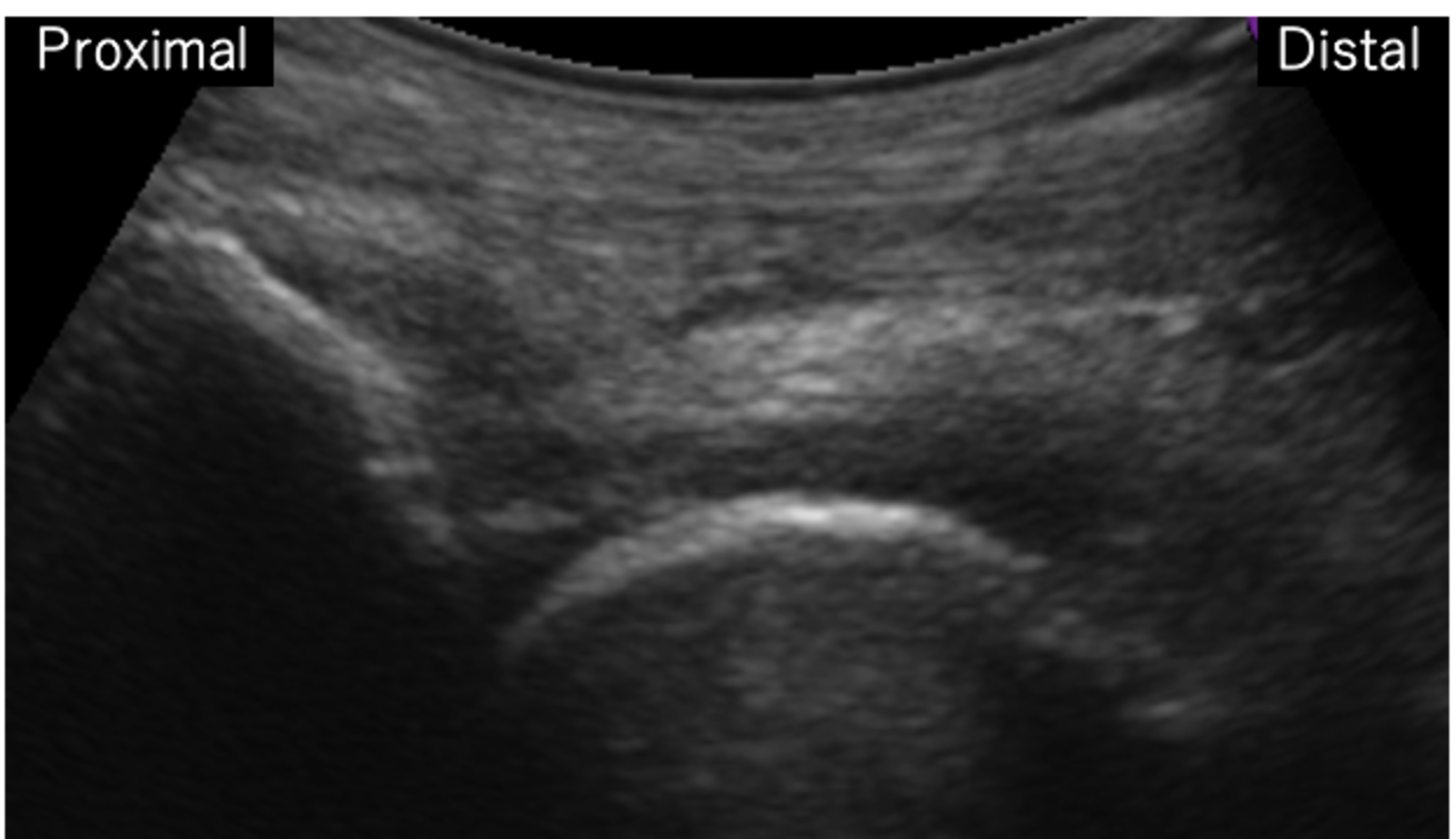 Cureus | Endoscopic Resection for Iliopectineal Bursitis Associated ...