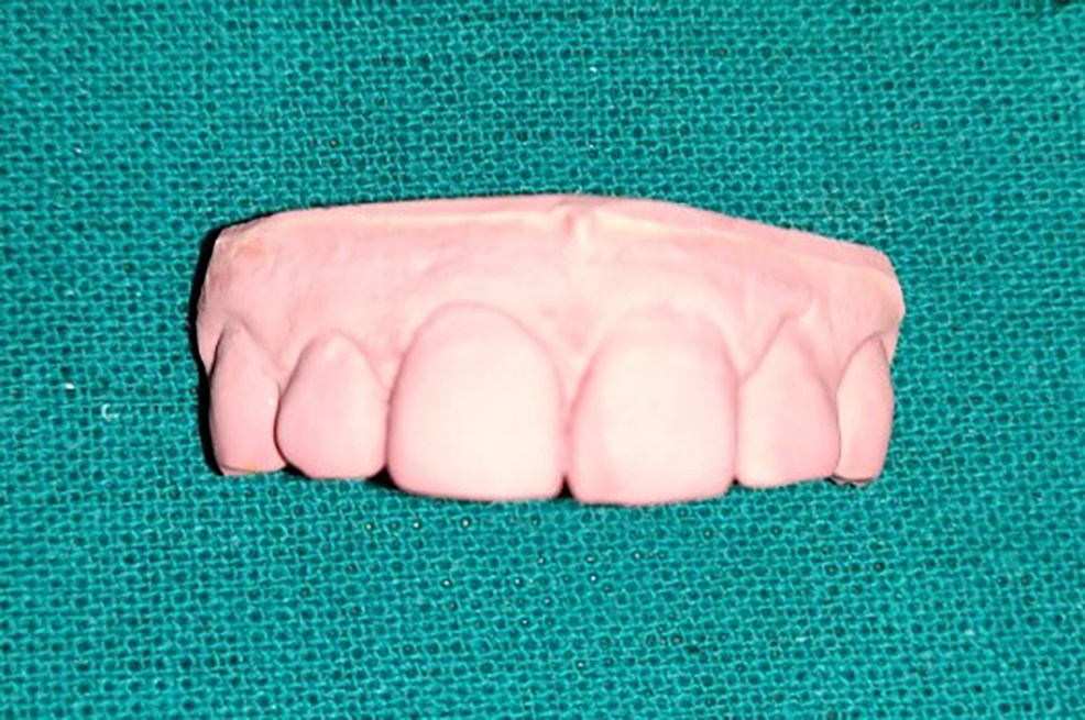 Cureus Comparative Evaluation of the Clinical Efficacy of Four