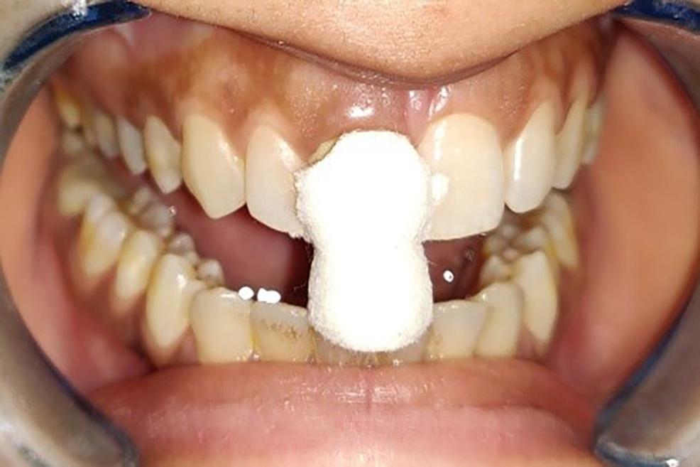 Cureus Comparative Evaluation of the Clinical Efficacy of Four