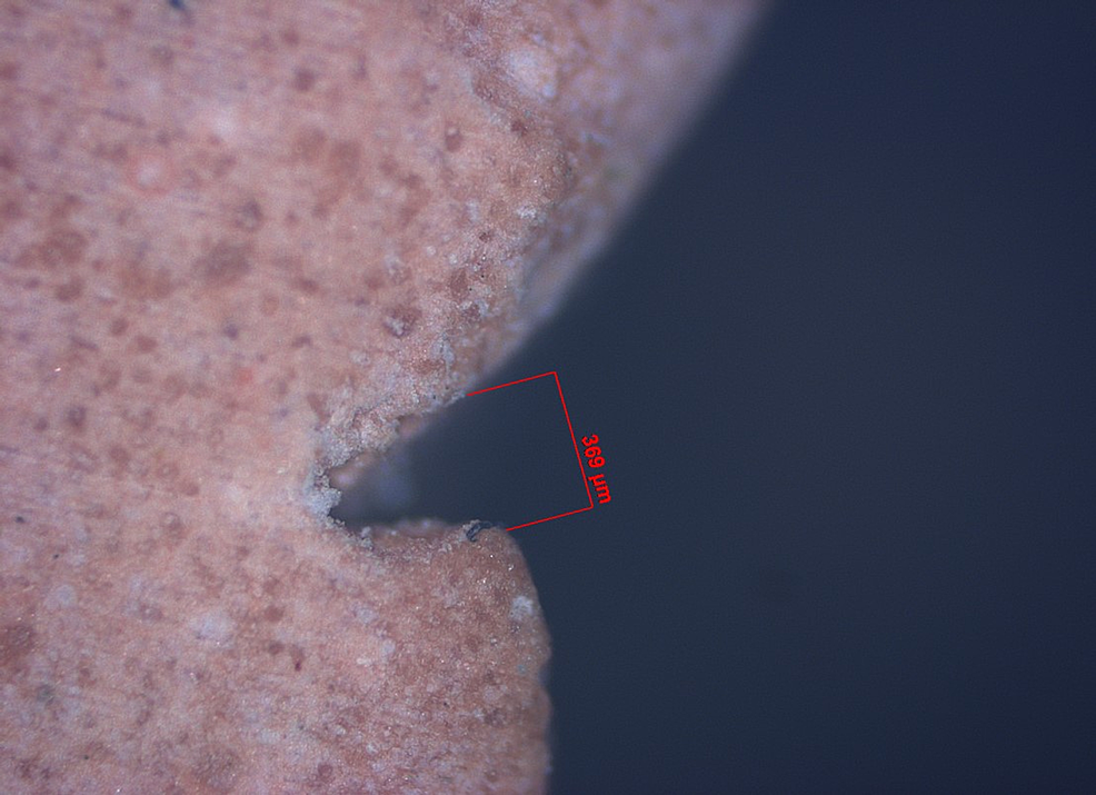 Cureus Comparative Evaluation of the Clinical Efficacy of Four