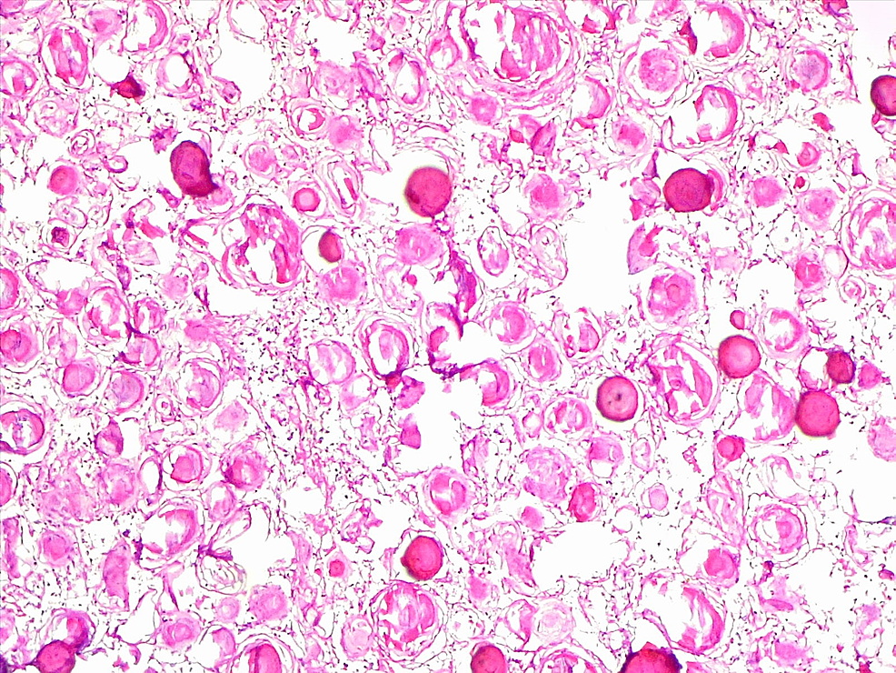 Photomicrograph-of-psammomatous-meningioma-showing-numerous-psammoma-bodies,-H&E-x100.