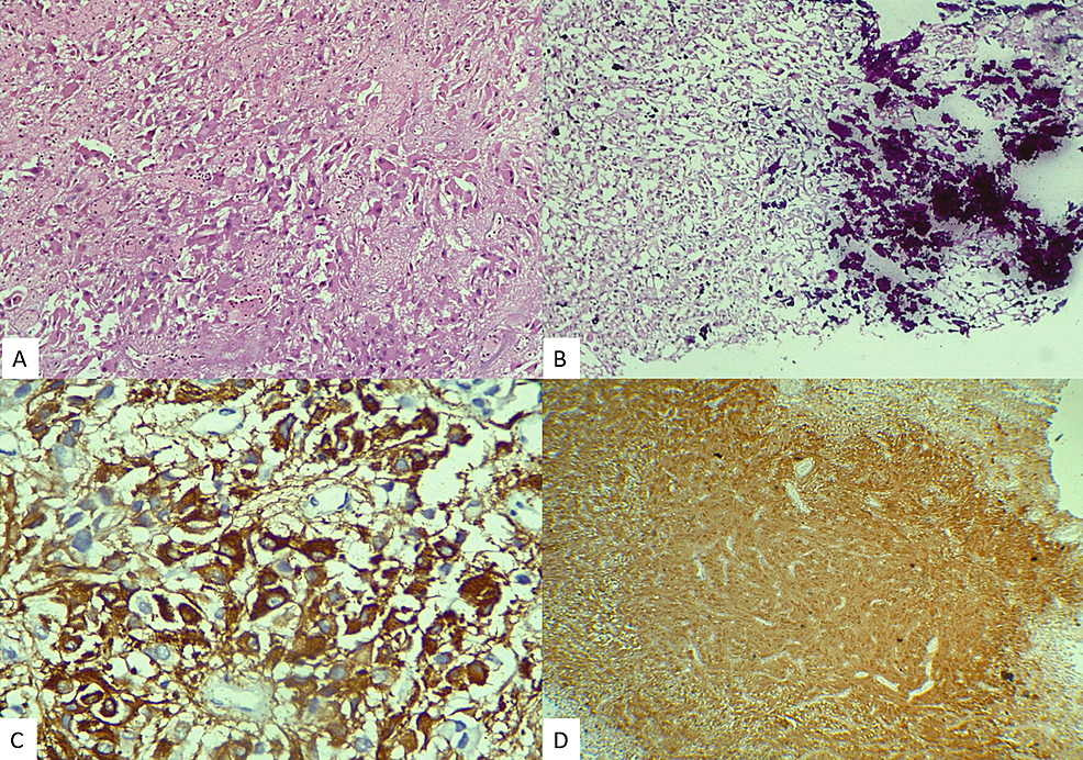 Photomicrograph-showing-sheets-of-large-polygonal-to-elongate-cells-resembling-astrocytes-or-ganglion-cells-with-abundant,-finely-granular-eosinophilic-cytoplasm.-H&E-x100-(A).-Extensive-calcification,-H&E-x100-(B).-Diffuse-GFAP-positivity-(C).-S100-positivity-(D).