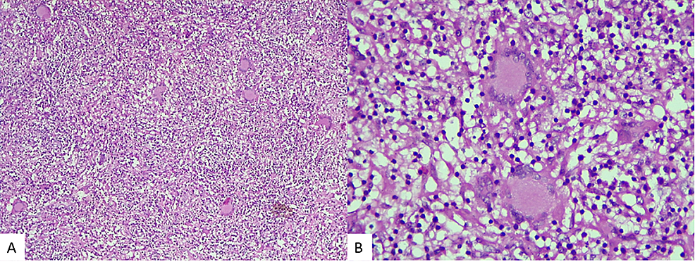 Photomicrograph-showing-formed-granulomas-comprising-of-non-caseating-type-of-central-necrosis-at-few-places-surrounded-by-epithelioid-cells,-lymphocytes,-and-many-Langhans-type-of-giant-cells.-H&E-x100-(A).-H&E-x400-(B).