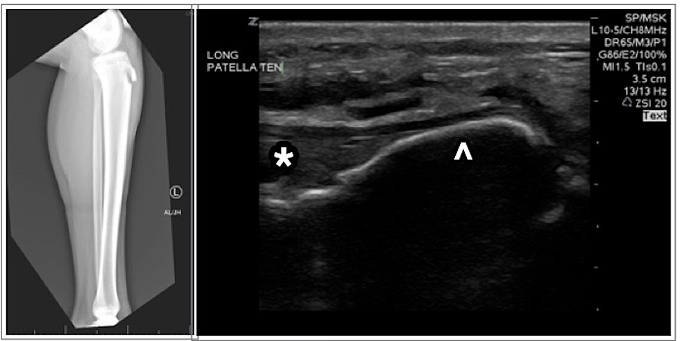 Tibial Spine Fractures  Florida Orthopaedic Institute