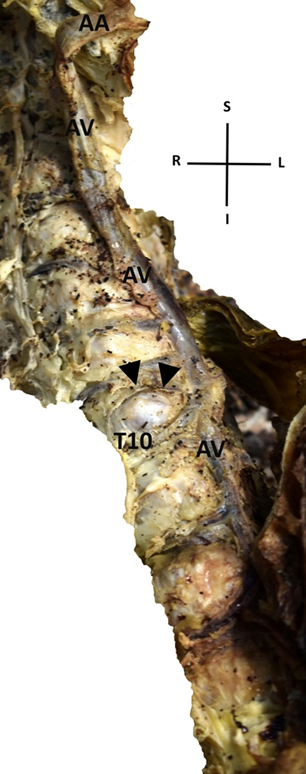 a left-sided azygos vein in a cadaver: anatomical and surgical