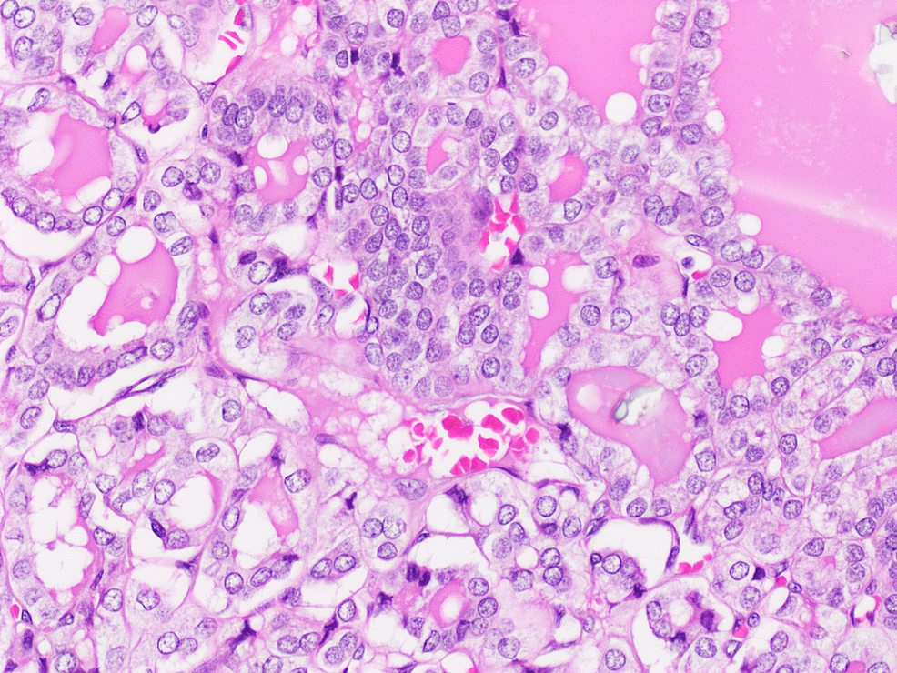 The-lining-cells-exhibit-nuclear-enlargement,-clearing,-overlapping,-and-nuclear-grooves,-hematoxylin-and-eosin-stained-section-(H&E;-x20).