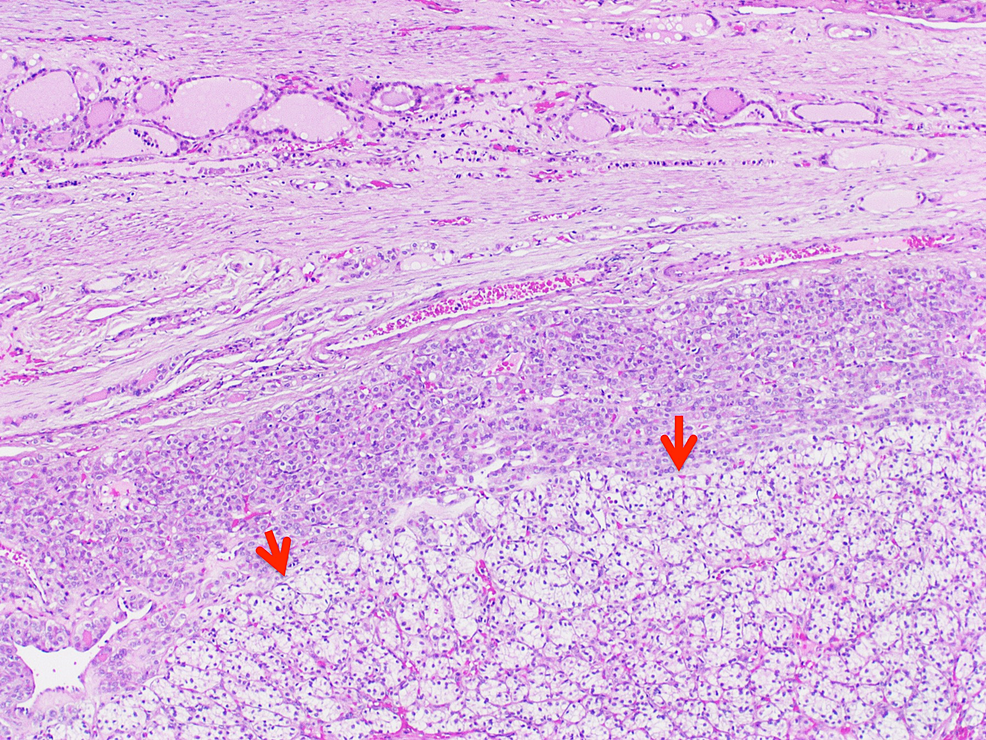 A-second-population-of-clear-cells-is-seen-adjacent-to-the-follicles-(red-arrows),-hematoxylin-and-eosin-stained-section-(H&E;-x4).