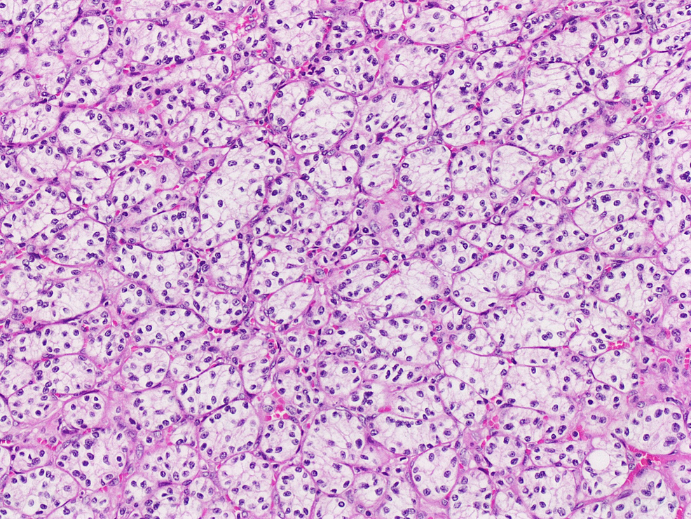 Clear-cells-are-arranged-in-nests-and-sheets-with-small-round-nuclei,-inconspicuous-nucleoli,-and-a-rich-vascular-background,-hematoxylin-and-eosin-stained-section-(H&E;-x10).