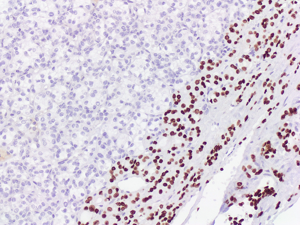 The-follicular-component-was-immunoreactive-for-TTF-1-(x10).