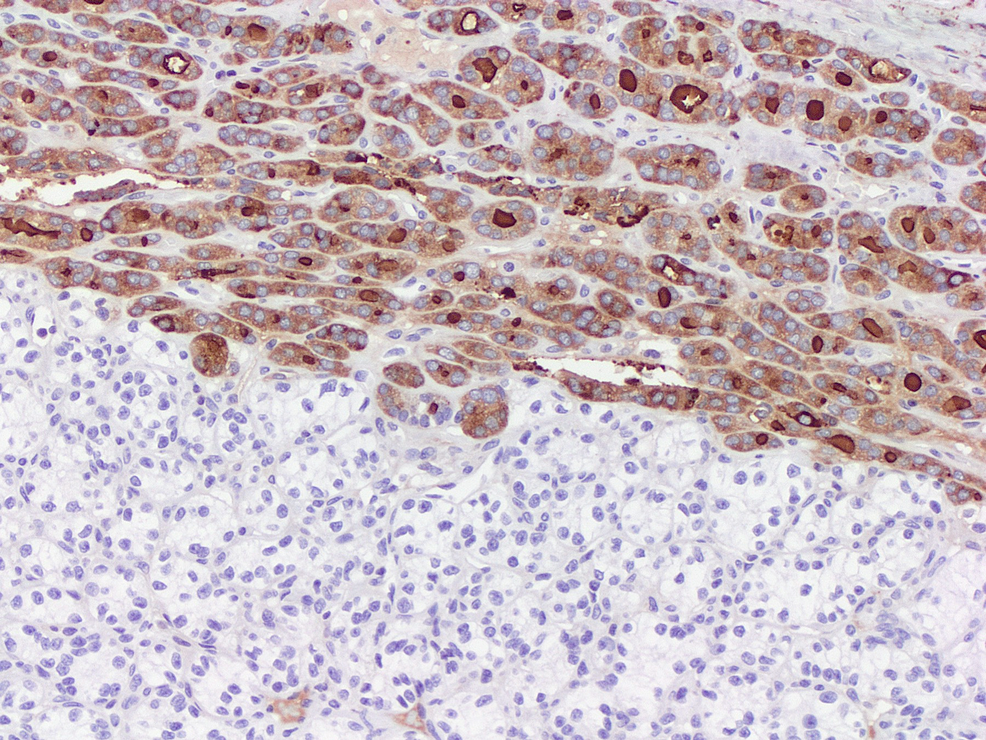 The-follicular-component-shows-immunoreactivity-for-thyroglobulin-(x10).