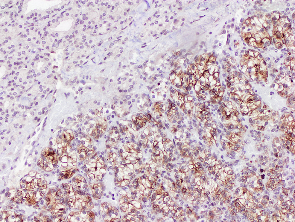 Membranous-staining-for-CD10-in-the-clear-cell-component-(x10).