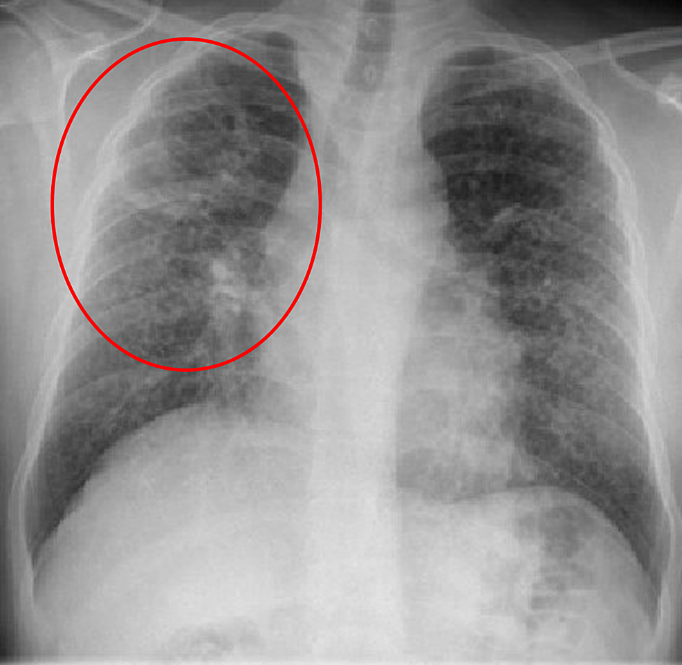 Chest-radiograph-showing-right-upper-lobe-cavitary-lung-lesion-and-diffuse-nodular-reticular-interstitial-opacities.