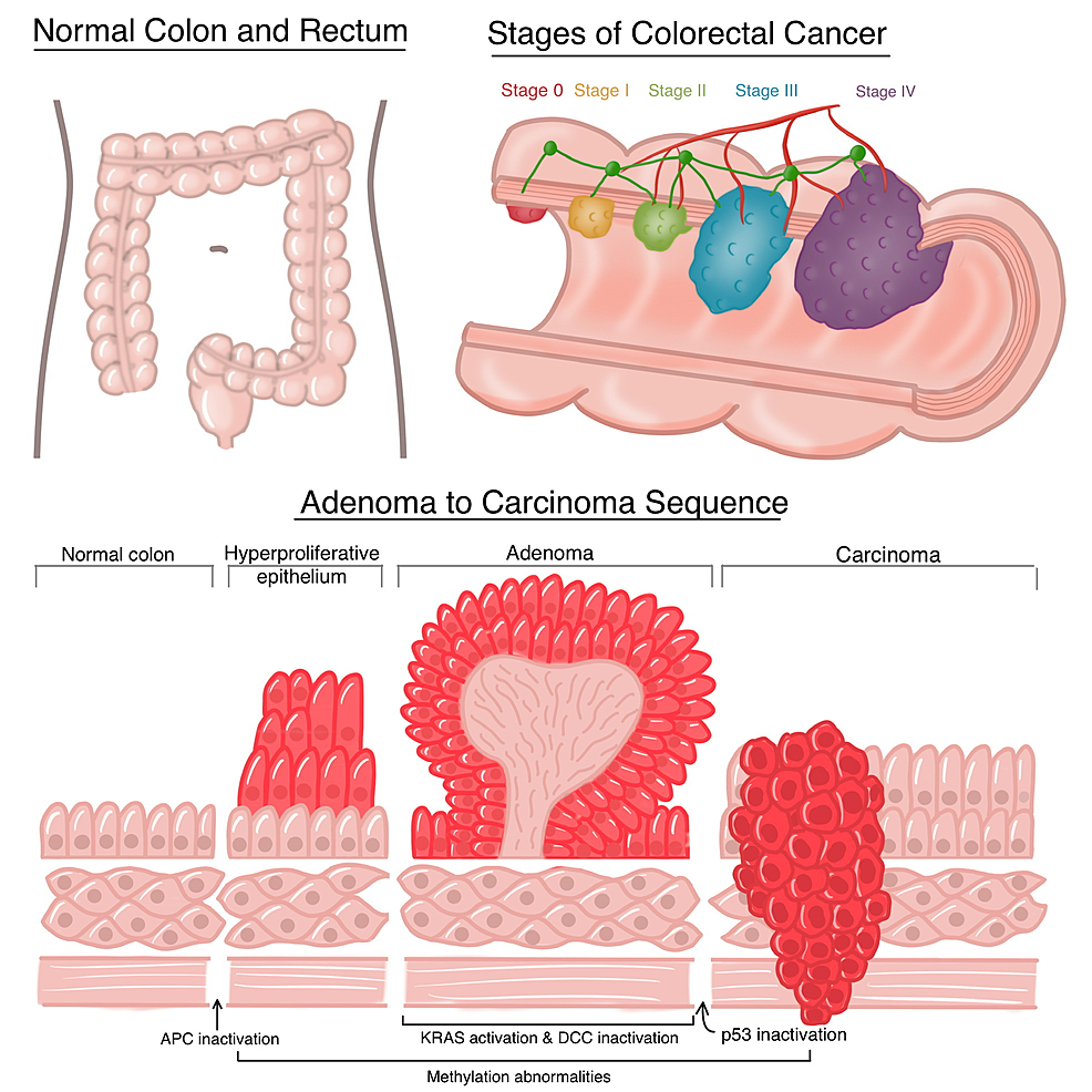 Comparison-of-the-histological-feature-of-normal-colon-cells,-adenoma,-and-colorectal-cancer-cells.-