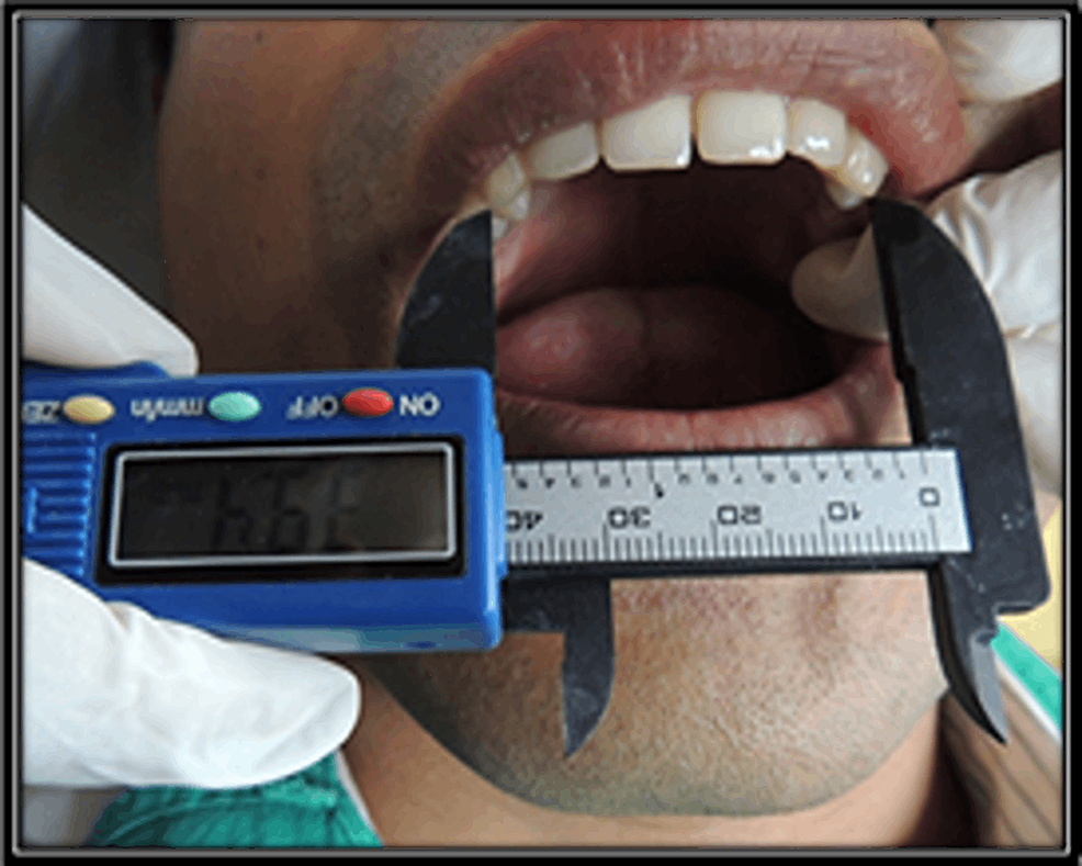 An Evaluation of the Relation Between Variation in Arch Forms and