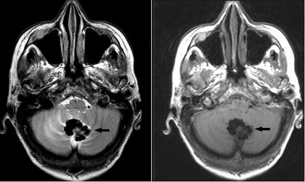 Cureus, Structural MRI Brain Alterations in Borderline Personality Disorder  and Bipolar Disorder