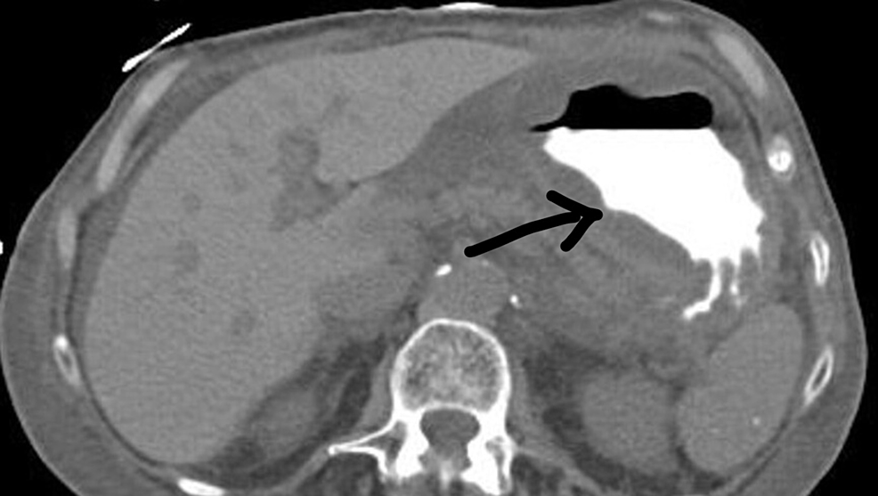 cureus-a-case-of-gastric-outlet-obstruction-secondary-to-parastomal