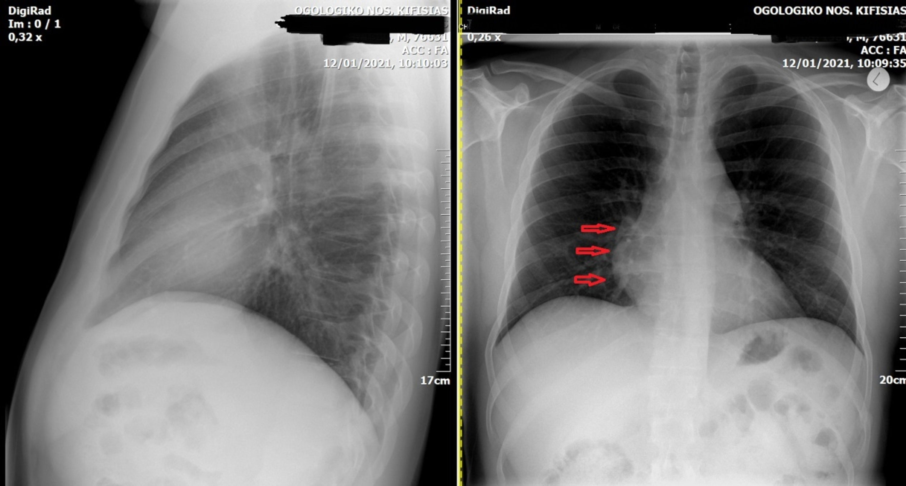 Cureus | A Case of an Inflamed Pericardial Cyst As the Cause of Acute ...