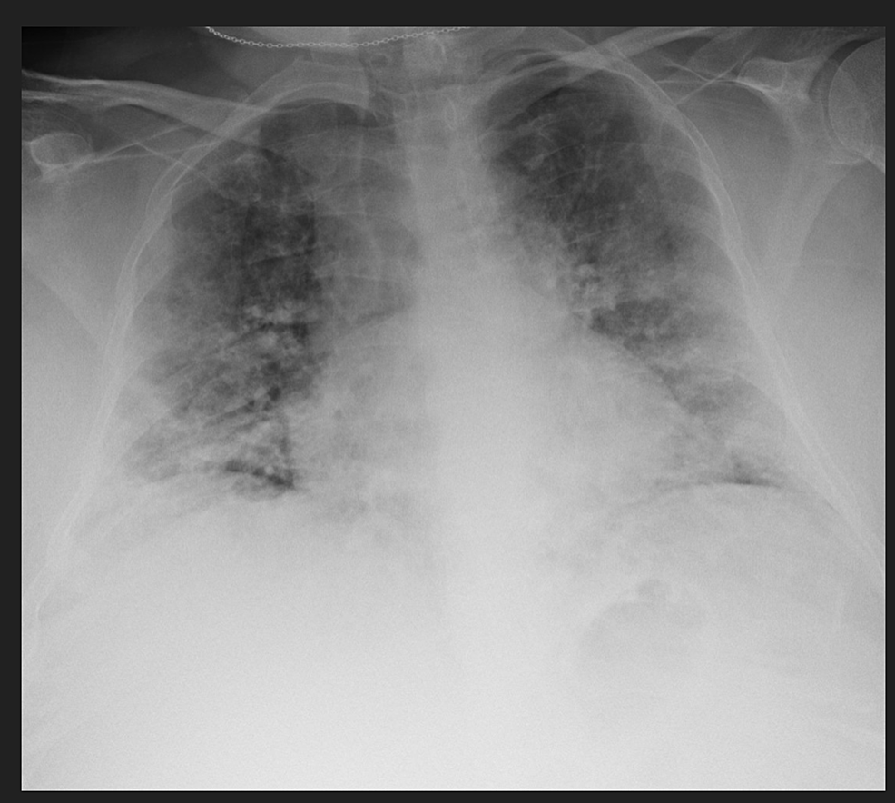 Cureus | Inferior Vena Cava Thrombosis in a Young Patient With COVID-19 ...