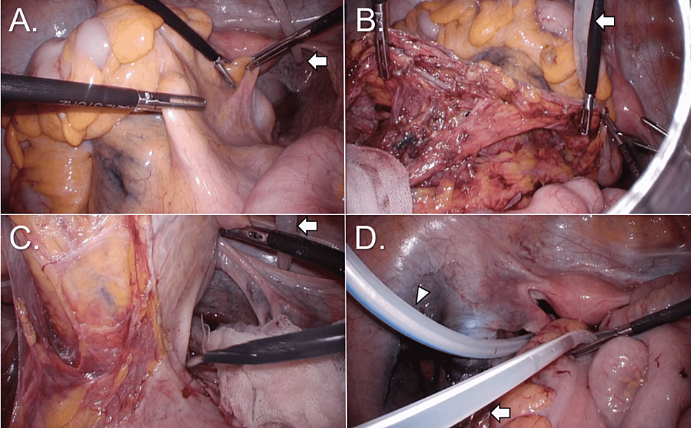 Intraoperative-findings-from-performing-a-laparoscopic-left-hemicolectomy-of-the-colon-(case-6).