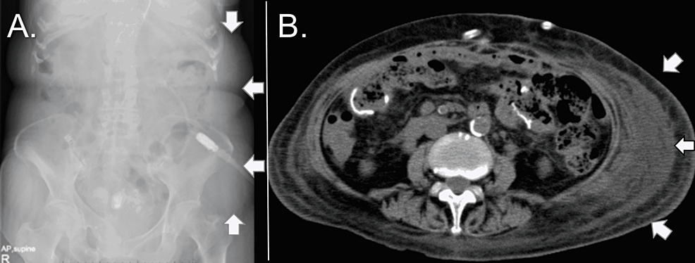 X-ray-and-CT-images-of-subcutaneous-edema-after-postoperative-peritoneal-dialysis-resumption-(case-3).