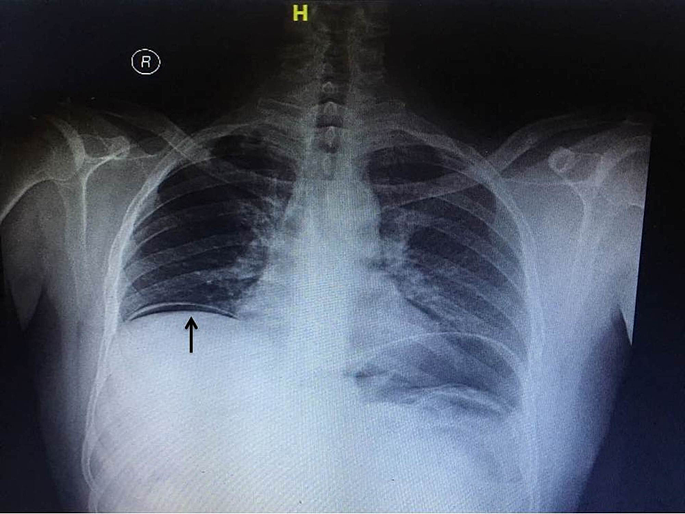 Fecal impaction, Radiology Reference Article