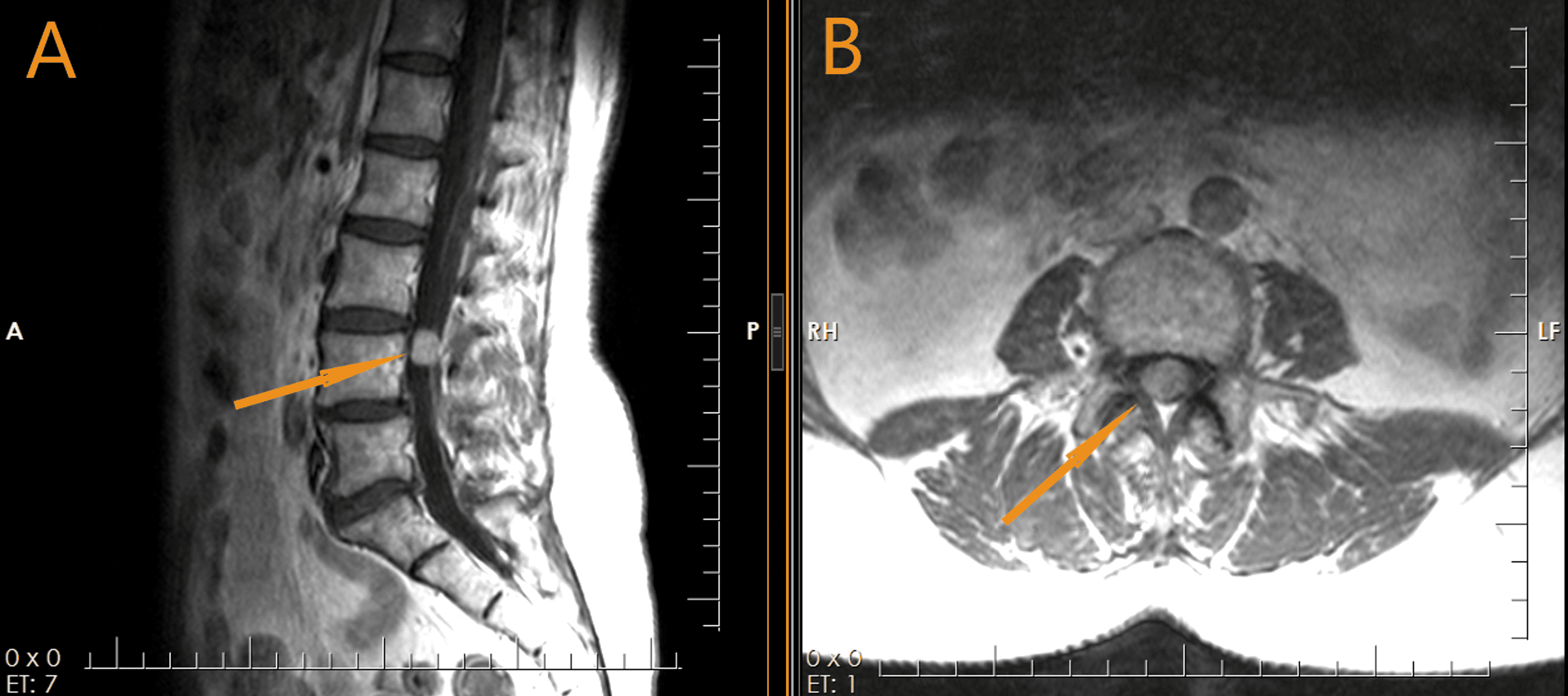 Cureus | Minimally Invasive Resection of a Gangliocytic Paraganglioma ...